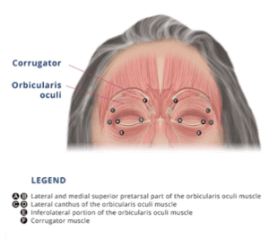 Diagram showing the muscles involved in blepharospasm.