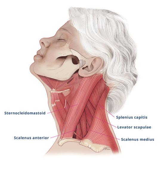 Diagram showing the muscles in the side of the neck possibly involved in cervical dystonia.