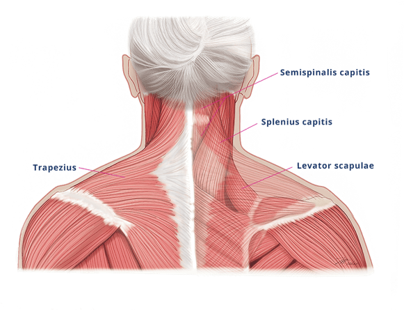 Diagram showing the muscles in the back of the neck possibly involved in cervical dystonia.