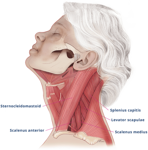 cervical dystonia pain